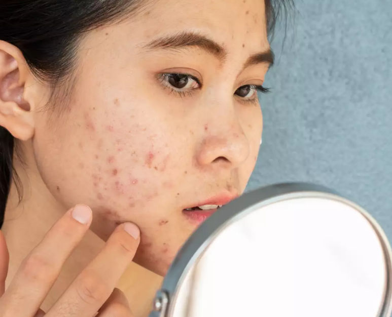 ऑयली स्किन के कारण हो रहा है एक्ने, तो इन बातों का रखें ध्यान