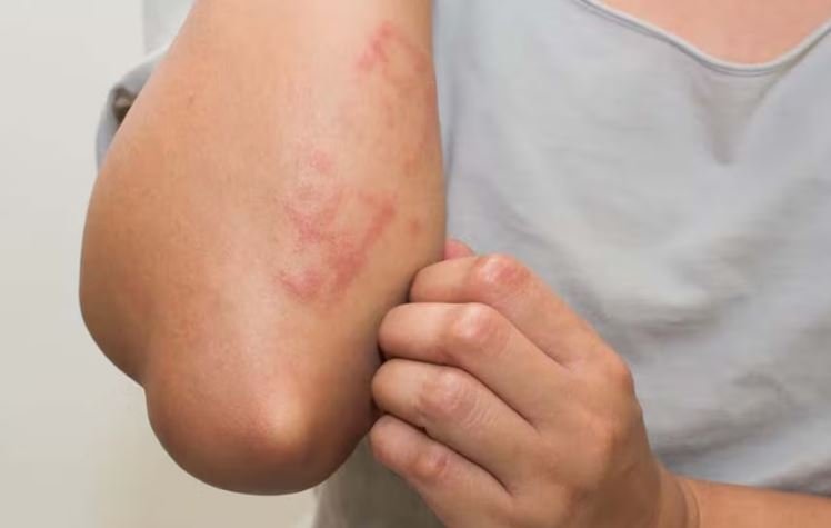जलन और खुजली से मिलेगी निजात